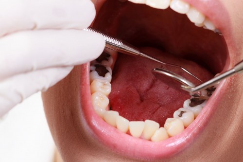 Sâu răng: Nguyên nhân, triệu chứng, chẩn đoán và điều trị