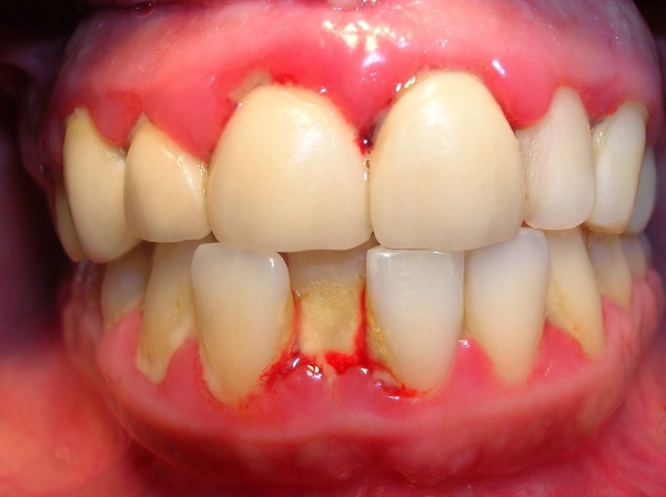 Cách trị dứt điểm viêm lợi_không cần kháng sinh