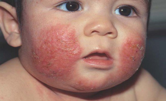 Viêm da cơ địa ở trẻ em có nguy hiểm không? Cách nhận biết và điều trị
